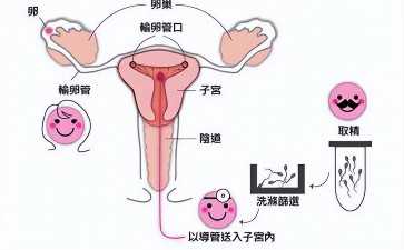 子宫腺肌症的治疗与运动辅助